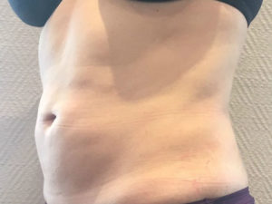 Photo après liposuccion ventre