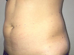 Photo avant liposuccion ventre