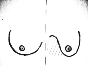 Seins tubéreux stade 1