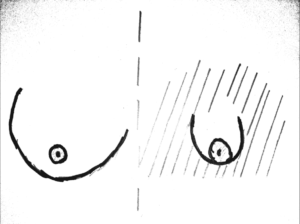 Seins tubéreux stade 3