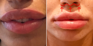 Chirurgie esthétique des lèvres - Exemples