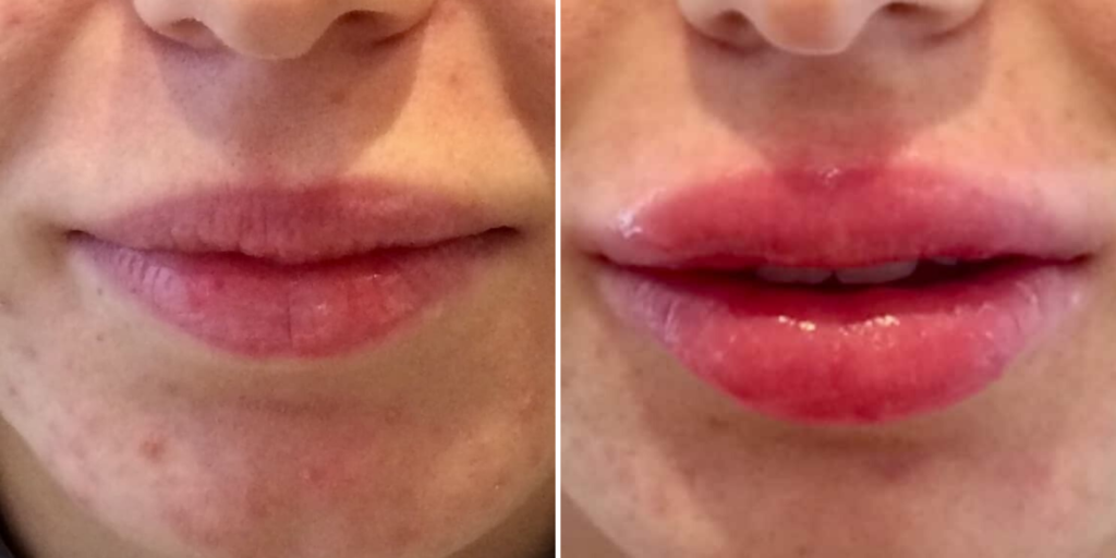 Chirurgie esthetique des lèvres de la bouche : avant / Après injection d'acide hyaluronique