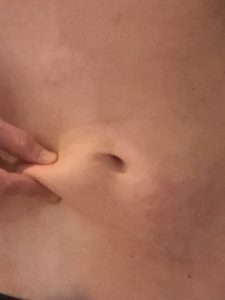 Avant/Après Cryolipolyse : photo après traitement