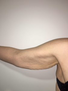 Bras avant lifting, la peau est distendue