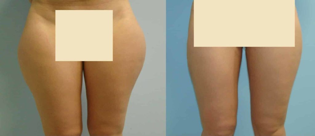 Exemple de avant - après chirurgie esthétique de la culotte de cheval