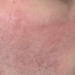 Cicatrices d'acné après dermabrasion chirurgical