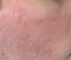 Cicatrices d'acné après dermabrasion chirurgical