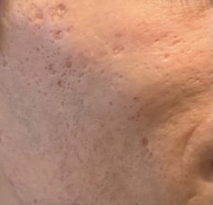 Cicatrices d'acné avant dermabrasion chirurgical