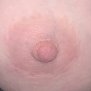 Cicatrice normale de prothèses mammaires 